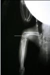 Radiograph fracture site