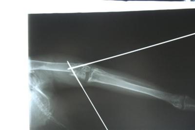 surgical pins inplanted in Falcon Leg